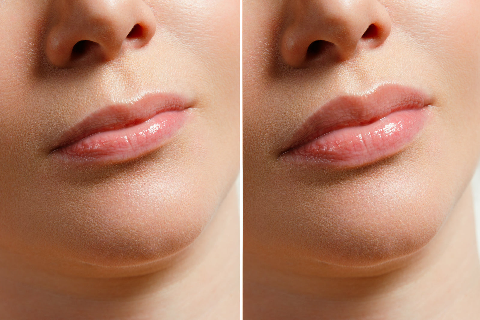 The Ultimate Guide to Natural Lip Volume: Mesotherapy & Micro-Needling