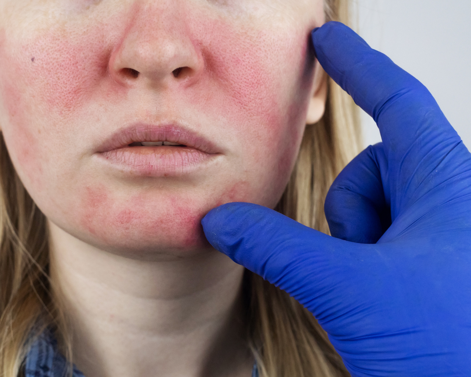 Rosacea & Sensitive Skin Specialist