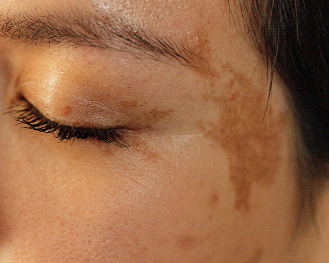 Hyperpigmentation Specialist: Melasma, PIH & Sun Damage