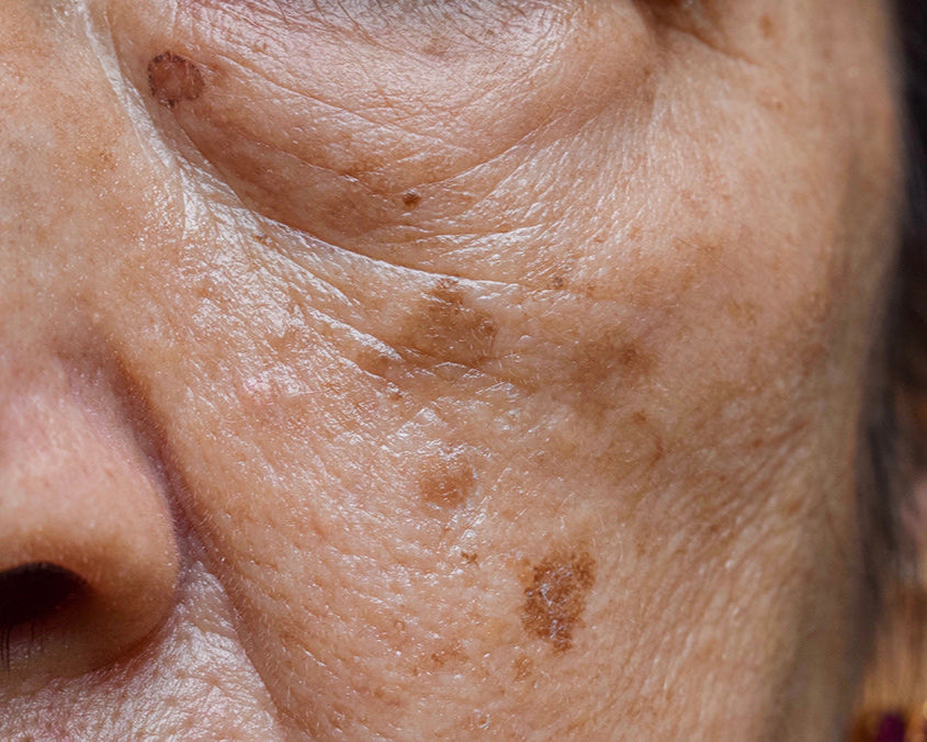 Hyperpigmentation Specialist: Post-Traumatic Pigmentation