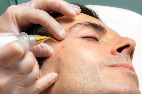 Plasma Fibroblast – Online Course – $295